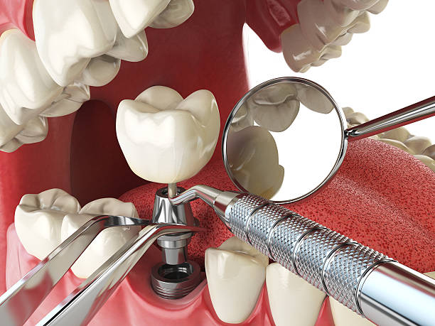 Best Emergency Root Canal Treatment in Maiden, NC